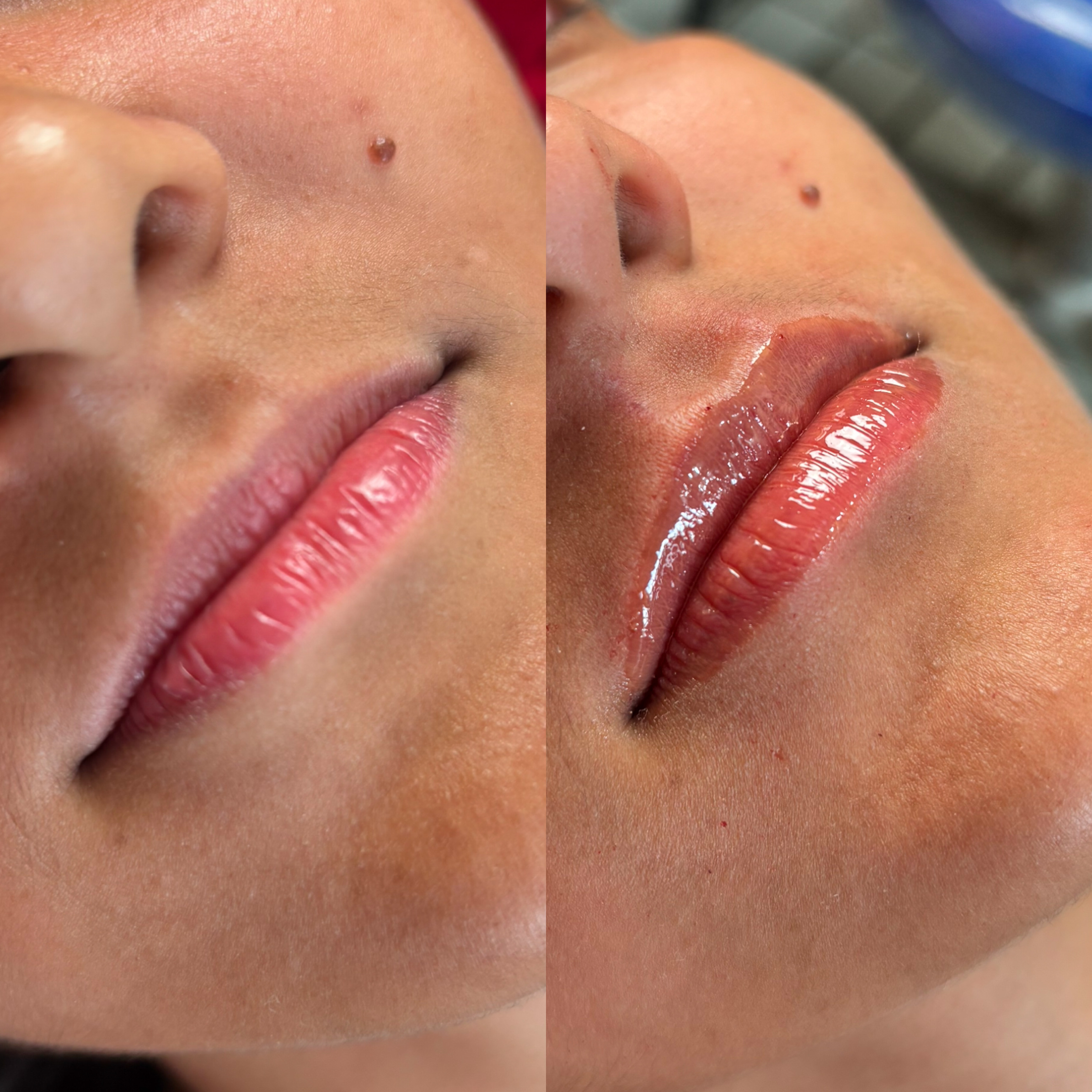 Antes e depois – preenchimento labial natural